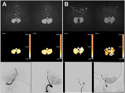 Delayed low cerebellar perfusion status is associated with poor outcomes in top-of-basilar occlusion treated with thrombectomy